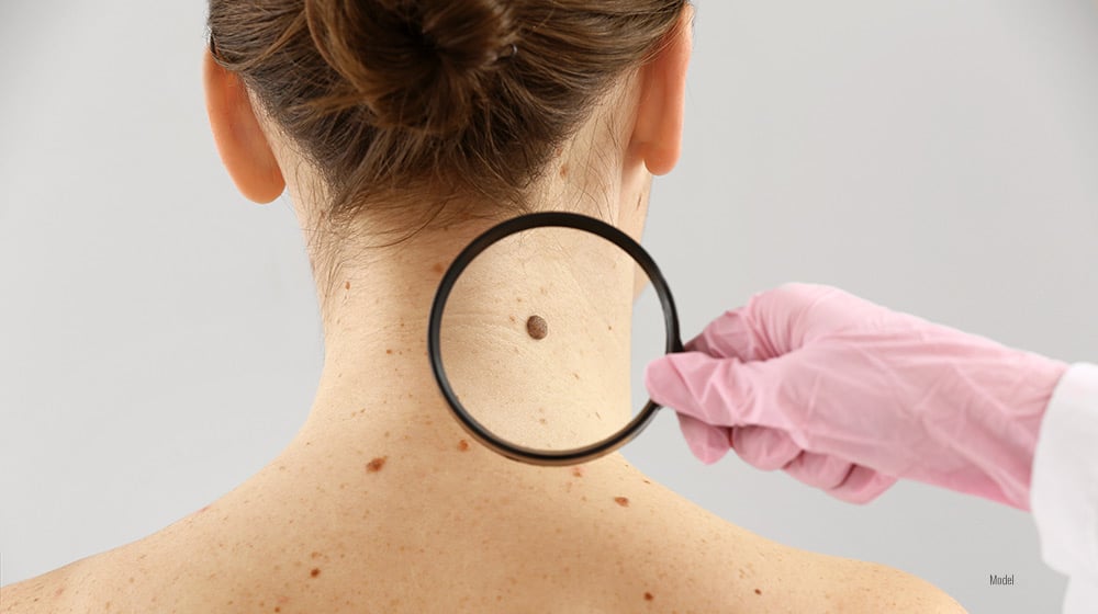 close-up of the back of a woman's neck covered in moles while someone else holds a magnifying glass over one of the moles.